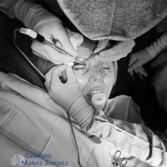 Blefaroplastia