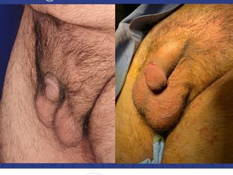 Alargamiento de pene antes y después - 800514