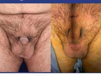 Alargamiento de pene antes y después - 800516