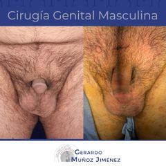 Antes y después de Alargamiento de pene