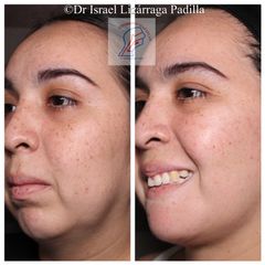 Antes y después de una Rinoplastia