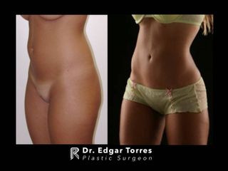 Antes y después de Lipoescultura