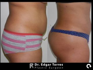 Antes y después de Lipoescultura