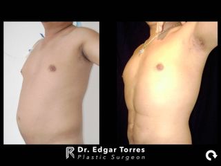 Antes y después de Lipoescultura