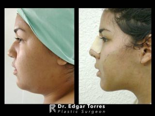 Antes y después de Microliposculpture