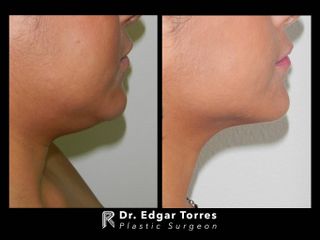 Antes y después de Microliposculpture