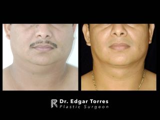 Antes y después de Microliposculpture