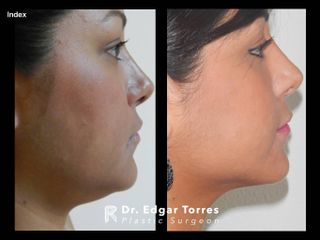 Antes y después de Microliposculpture