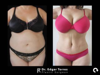 Antes y después de Abdominoplastia