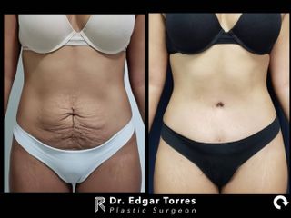 Antes y después de Abdominoplastia