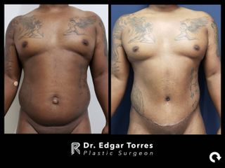Antes y después de Abdominoplastia