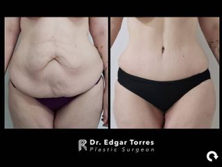 Antes y después de Abdominoplastia