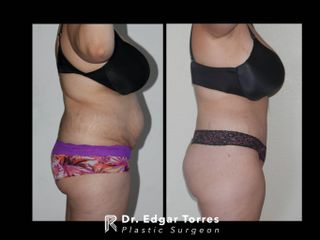 Antes y después de Torsoplastia