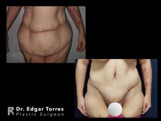 Antes y después de Torsoplastia