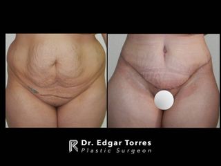 Antes y después de Torsoplastia