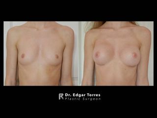 Antes y después de Mamoplastia de aumento