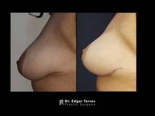 Antes y después de Mastopexia