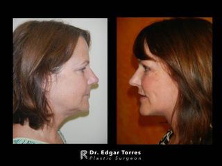 Antes y después de Facelift and neck