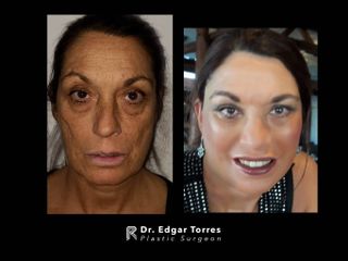 Antes y después de Face lift and neck