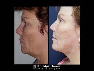 Antes y después de Facelift and neck