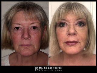 Antes y después de Facelift and neck