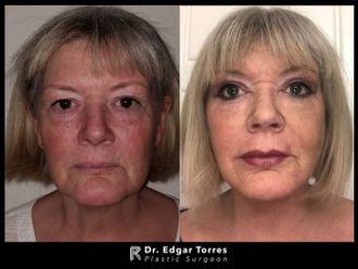 Rejuvenecimiento facial - 649913