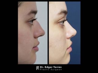 Antes y después de Rinoplastia