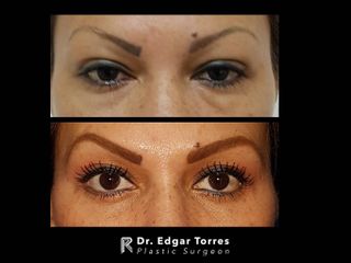 Antes y después de Blefaroplastia