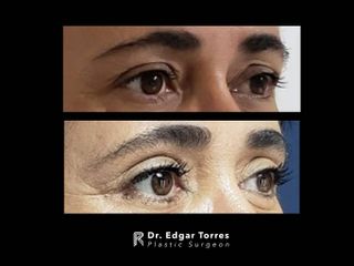 Antes y después de Blefaroplastia