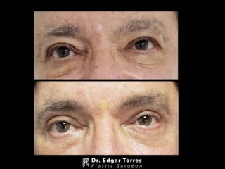 Antes y después de Blefaroplastia