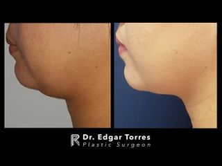 Antes y después de Microliposculpture