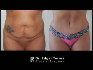 Antes y después de Abdominoplastia