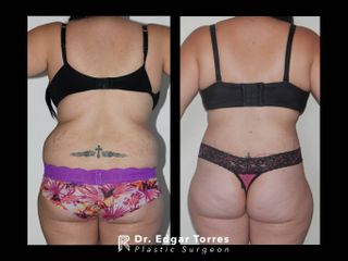 Antes y después de Torsoplastia