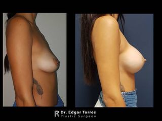 Antes y después de Mamoplastia de aumento