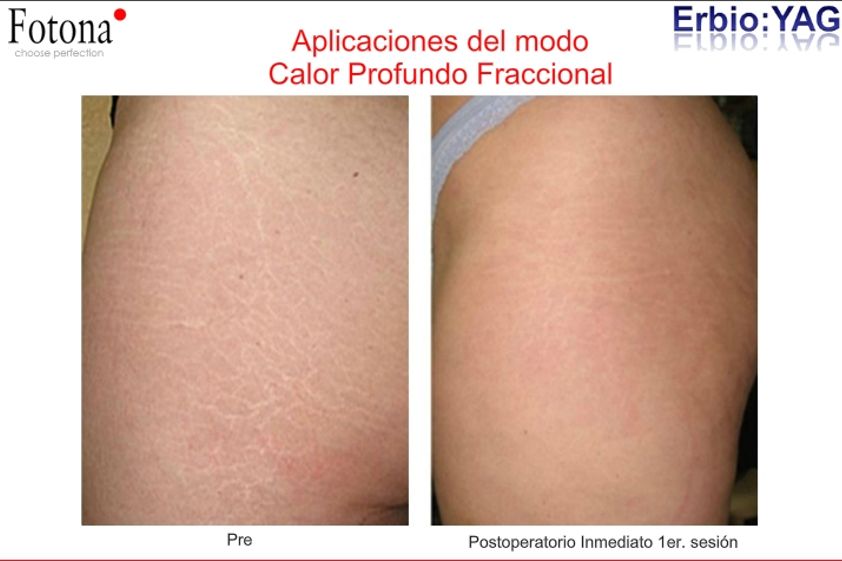 Eliminación estrías antes y después - 283880