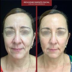 Rejuvenecimiento facial - Dra. Dafne Arellano Montalvo