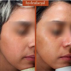 Rejuvenecimiento facial - Dra. Dafne Arellano Montalvo