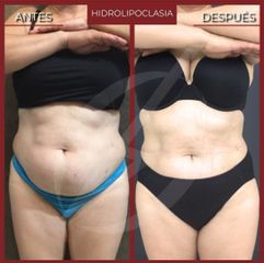 Hidrolipoclasia