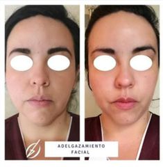 Adelgazamiento facial