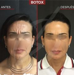 toxina botulínica frente