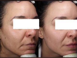 Rejuvenecimiento facial - Dra. Dafne Arellano Montalvo