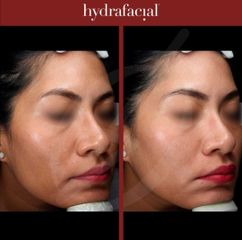 Rejuvenecimiento facial - Dra. Dafne Arellano Montalvo