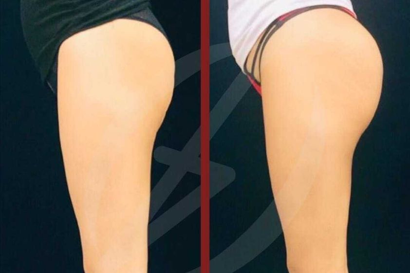 Hiperhidrosis antes y después - 787136