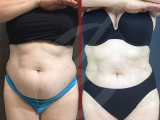 Hiperhidrosis antes y después - 787137