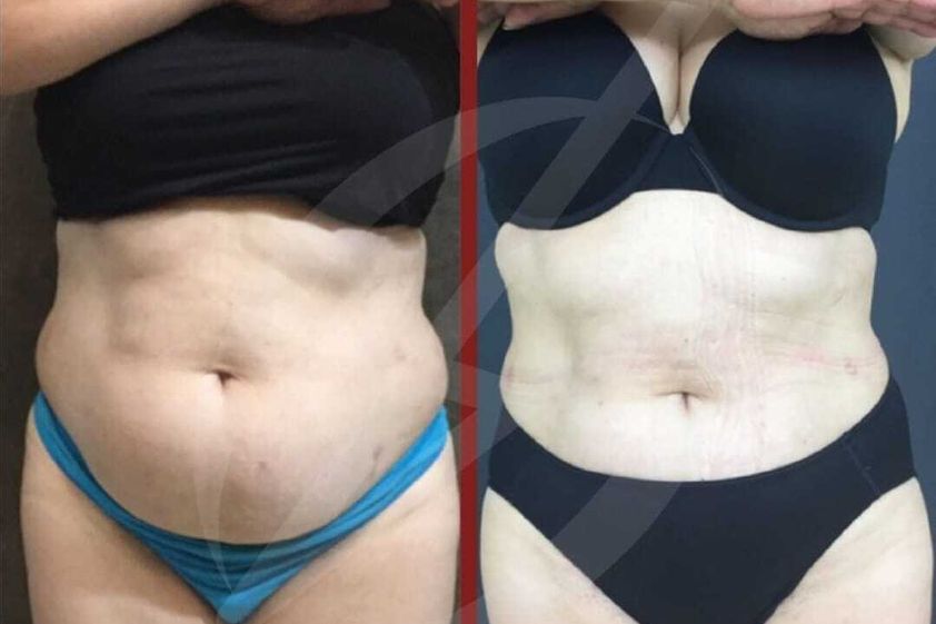 Hiperhidrosis antes y después - 787137