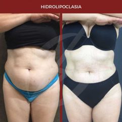 Hiperhidrosis - Dra. Dafne Arellano Montalvo