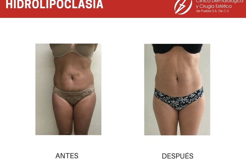 Hiperhidrosis antes y después - 787140