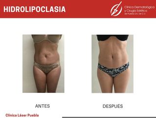 Hiperhidrosis - Dra. Dafne Arellano Montalvo