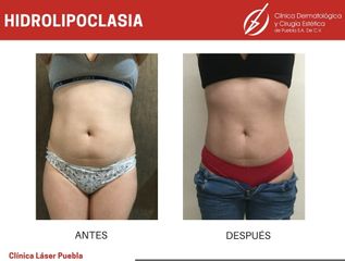 Hiperhidrosis - Dra. Dafne Arellano Montalvo