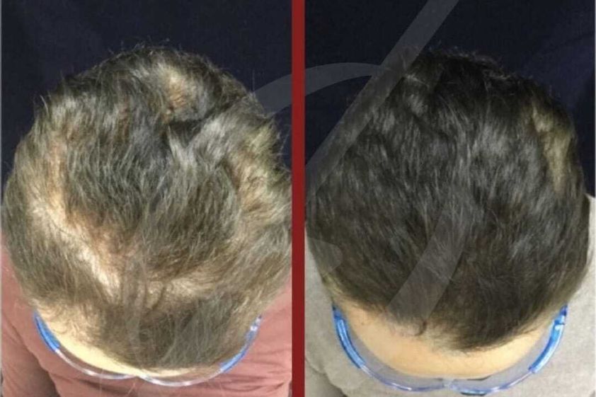 Alopecia antes y después - 787144